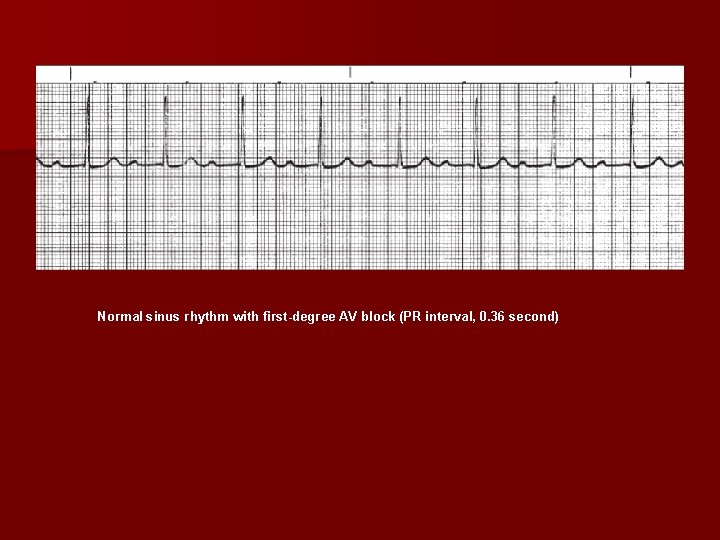 Normal sinus rhythm with first degree AV block (PR interval, 0. 36 second) 