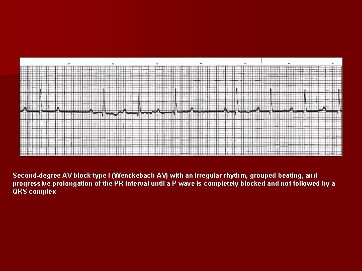 Second degree AV block type I (Wenckebach AV) with an irregular rhythm, grouped beating,