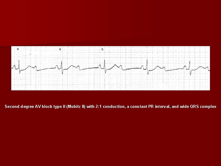 Second degree AV block type II (Mobitz II) with 2: 1 conduction, a constant