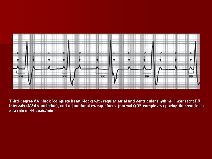 Third degree AV block (complete heart block) with regular atrial and ventricular rhythms, inconstant