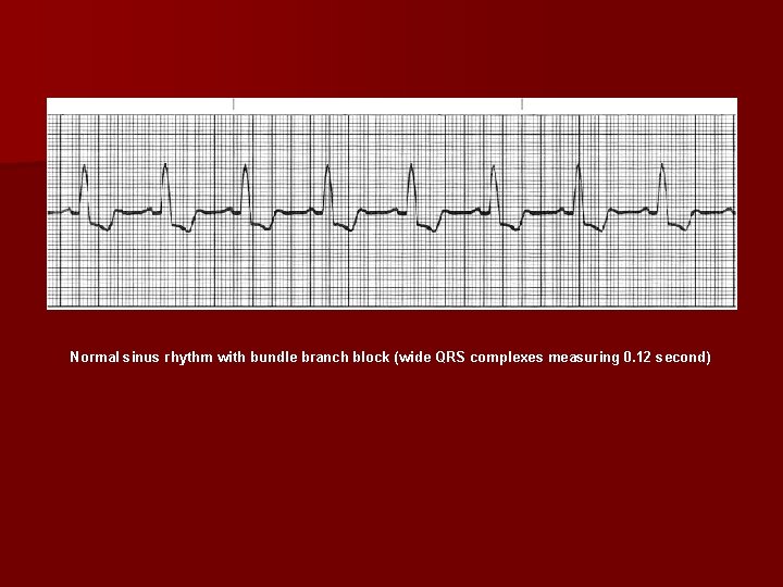 Normal sinus rhythm with bundle branch block (wide QRS complexes measuring 0. 12 second)