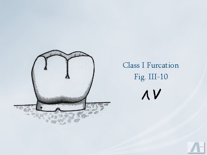 Class I Furcation Fig. III-10 