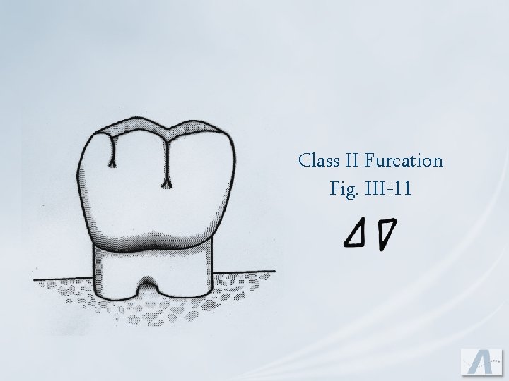 Class II Furcation Fig. III-11 