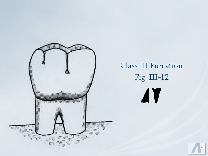 Class III Furcation Fig. III-12 
