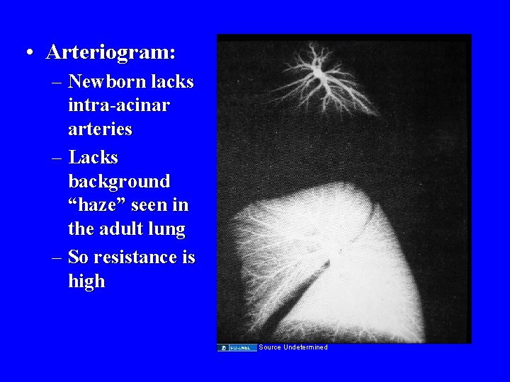  • Arteriogram: – Newborn lacks intra-acinar arteries – Lacks background “haze” seen in