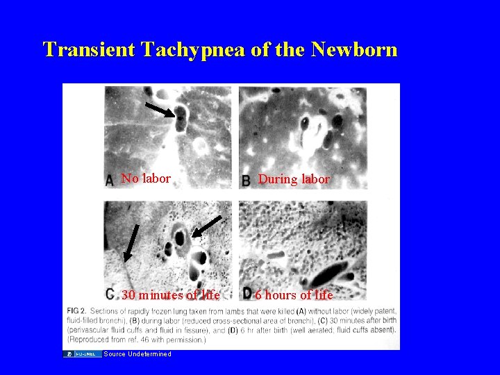 Transient Tachypnea of the Newborn No labor During labor 30 minutes of life 6