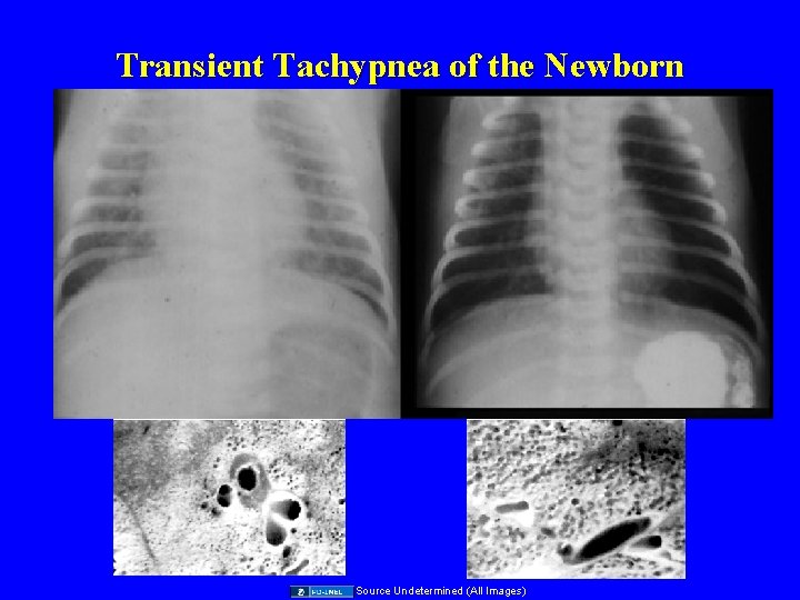 Transient Tachypnea of the Newborn Source Undetermined (All Images) 