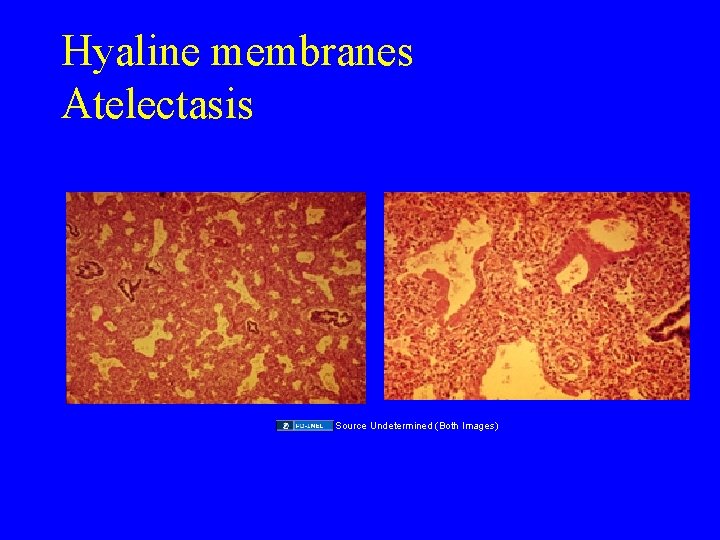 Hyaline membranes Atelectasis Source Undetermined (Both Images) 