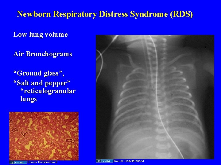 Newborn Respiratory Distress Syndrome (RDS) Low lung volume Air Bronchograms “Ground glass”, “Salt and