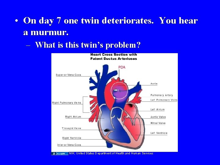  • On day 7 one twin deteriorates. You hear a murmur. – What