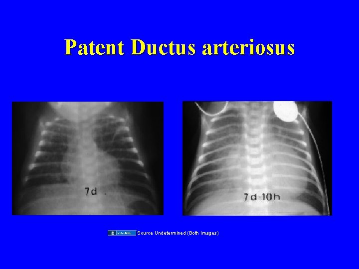 Patent Ductus arteriosus Source Undetermined (Both Images) 