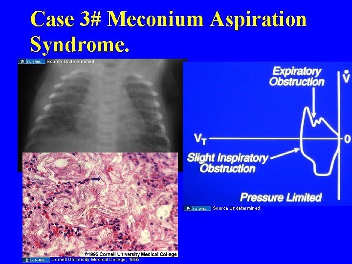 Case 3# Meconium Aspiration Syndrome. Source Undetermined Cornell University Medical College, 1995 