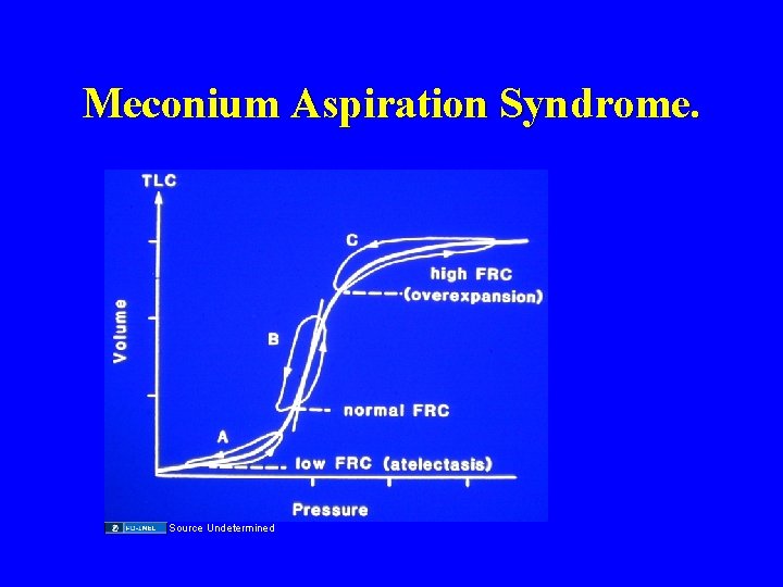 Meconium Aspiration Syndrome. Source Undetermined 