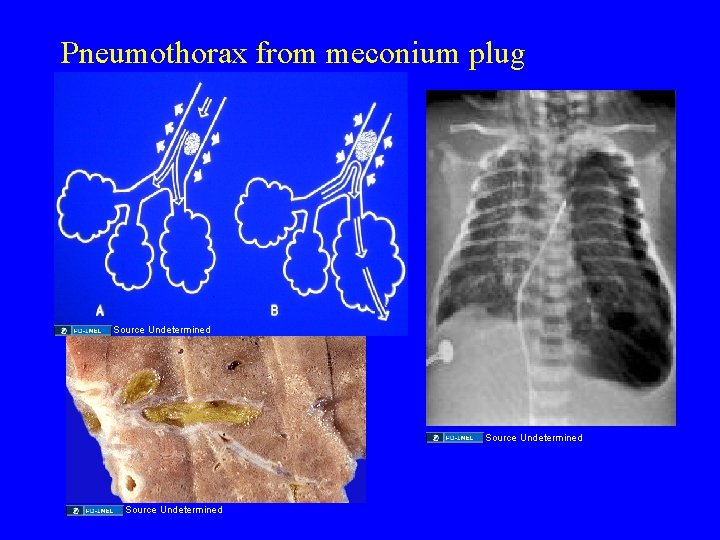 Pneumothorax from meconium plug Source Undetermined 