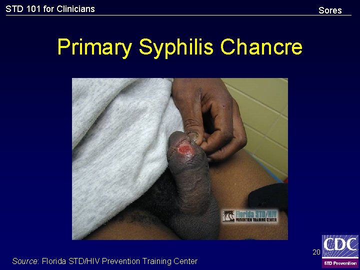 STD 101 for Clinicians Sores Primary Syphilis Chancre 20 Source: Florida STD/HIV Prevention Training