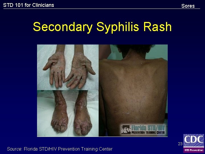 STD 101 for Clinicians Sores Secondary Syphilis Rash 23 Source: Florida STD/HIV Prevention Training