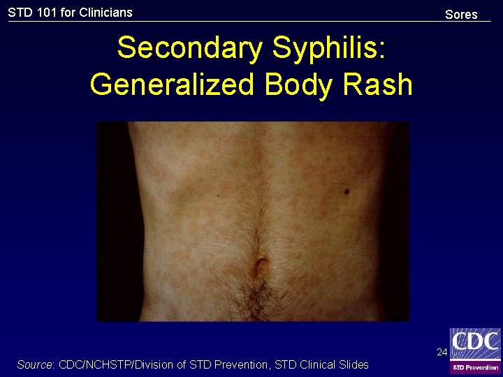 STD 101 for Clinicians Sores Secondary Syphilis: Generalized Body Rash 24 Source: CDC/NCHSTP/Division of