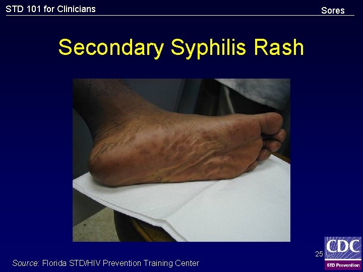 STD 101 for Clinicians Sores Secondary Syphilis Rash 25 Source: Florida STD/HIV Prevention Training