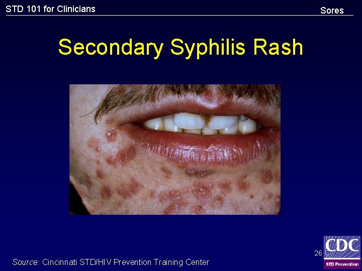 STD 101 for Clinicians Sores Secondary Syphilis Rash 26 Source: Cincinnati STD/HIV Prevention Training