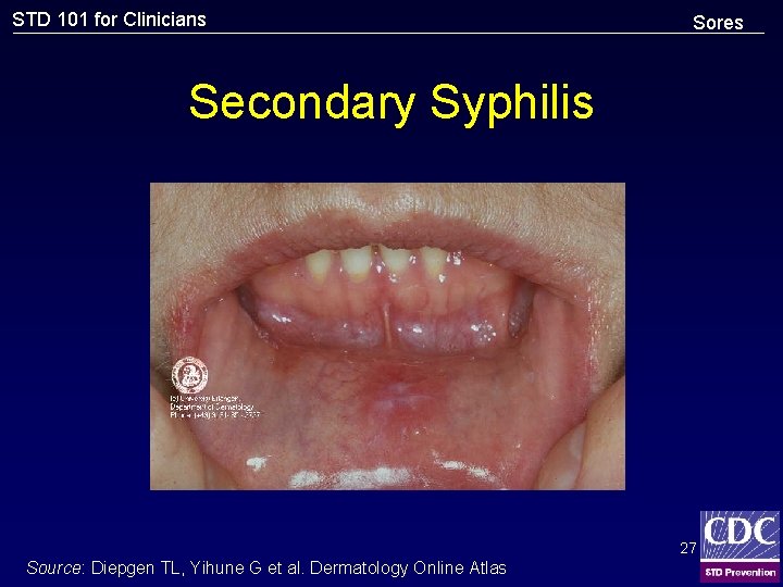 STD 101 for Clinicians Sores Secondary Syphilis 27 Source: Diepgen TL, Yihune G et