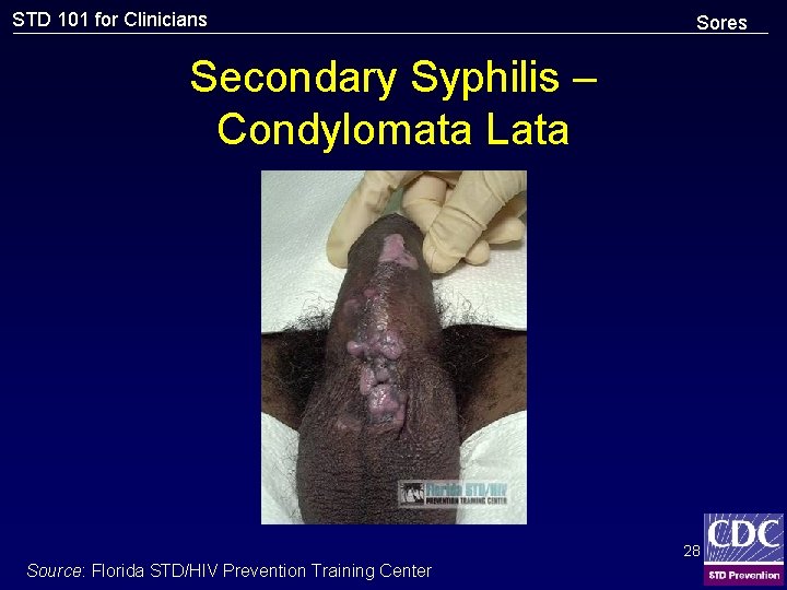 STD 101 for Clinicians Sores Secondary Syphilis – Condylomata Lata 28 Source: Florida STD/HIV