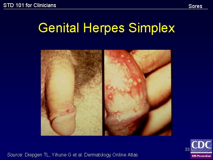 STD 101 for Clinicians Sores Genital Herpes Simplex 33 Source: Diepgen TL, Yihune G