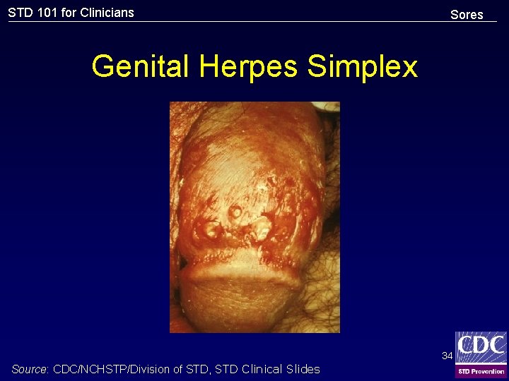 STD 101 for Clinicians Sores Genital Herpes Simplex 34 Source: CDC/NCHSTP/Division of STD, STD