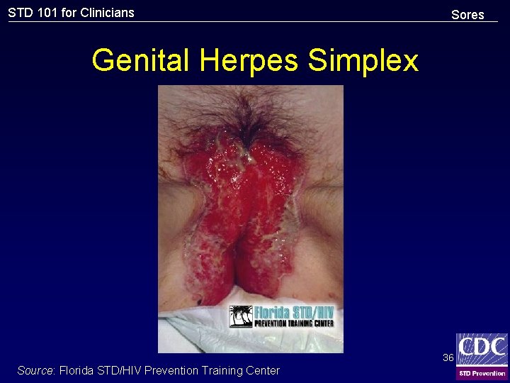 STD 101 for Clinicians Sores Genital Herpes Simplex 36 Source: Florida STD/HIV Prevention Training