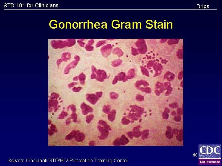 STD 101 for Clinicians Drips Gonorrhea Gram Stain 40 Source: Cincinnati STD/HIV Prevention Training