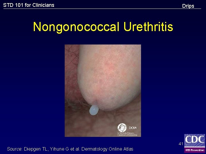 STD 101 for Clinicians Drips Nongonococcal Urethritis 41 Source: Diepgen TL, Yihune G et