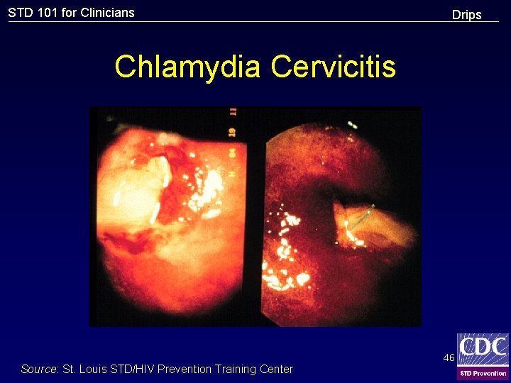 STD 101 for Clinicians Drips Chlamydia Cervicitis Source: St. Louis STD/HIV Prevention Training Center