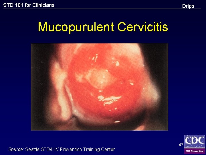 STD 101 for Clinicians Drips Mucopurulent Cervicitis Source: Seattle STD/HIV Prevention Training Center 47