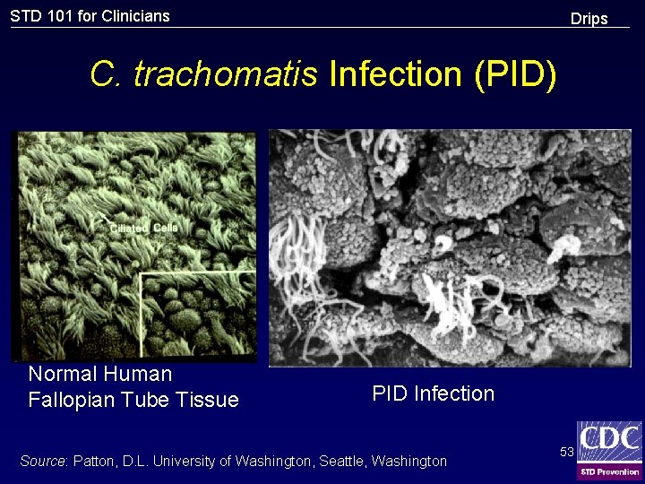 STD 101 for Clinicians Drips C. trachomatis Infection (PID) Normal Human Fallopian Tube Tissue