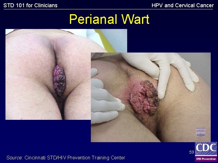 HPV and Cervical Cancer STD 101 for Clinicians Perianal Wart 59 Source: Cincinnati STD/HIV