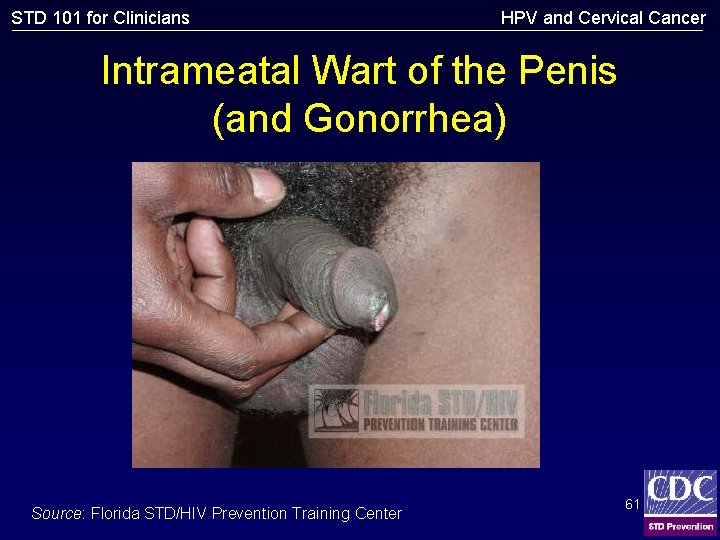 STD 101 for Clinicians HPV and Cervical Cancer Intrameatal Wart of the Penis (and