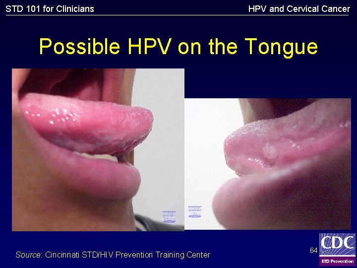 STD 101 for Clinicians HPV and Cervical Cancer Possible HPV on the Tongue Source: