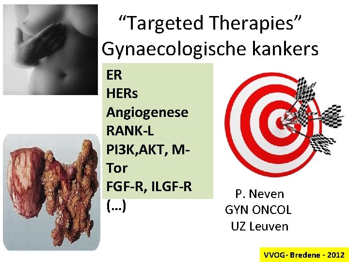 “Targeted Therapies” Gynaecologische kankers ER HERs Angiogenese RANK-L PI 3 K, AKT, MTor FGF-R,