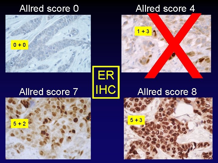 Allred score 0 X Allred score 4 1 + 3 0 + 0 Allred Allred score 0 X Allred score 4 1 + 3 0 + 0 Allred
