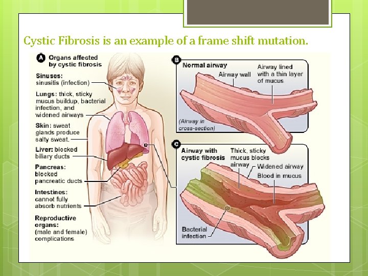 Cystic Fibrosis is an example of a frame shift mutation. 