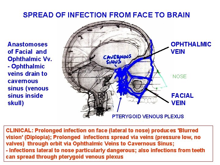 SPREAD OF INFECTION FROM FACE TO BRAIN Anastomoses of Facial and Ophthalmic Vv. -