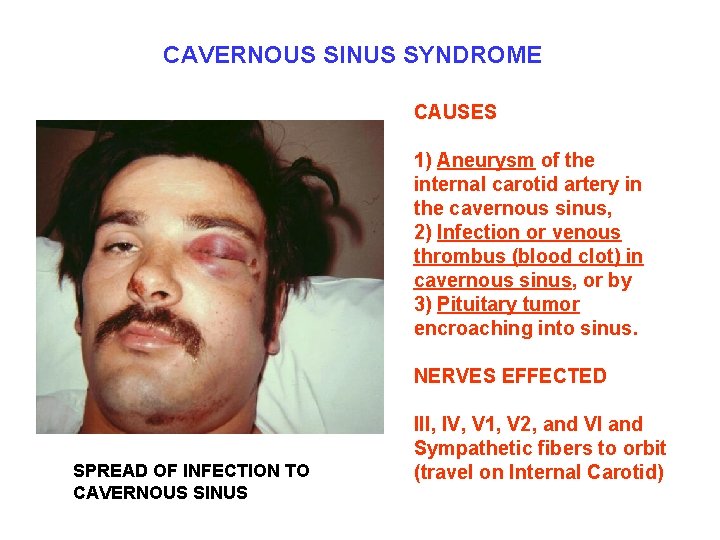 CAVERNOUS SINUS SYNDROME CAUSES 1) Aneurysm of the internal carotid artery in the cavernous