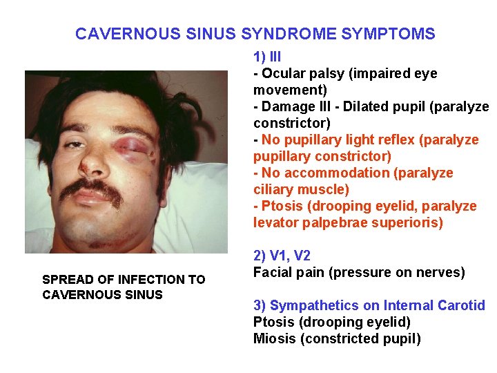 CAVERNOUS SINUS SYNDROME SYMPTOMS 1) III - Ocular palsy (impaired eye movement) - Damage