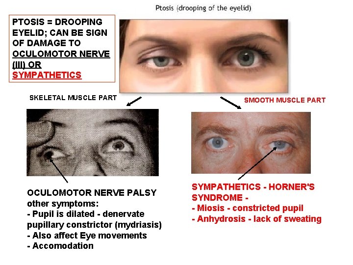 PTOSIS = DROOPING EYELID; CAN BE SIGN OF DAMAGE TO OCULOMOTOR NERVE (III) OR