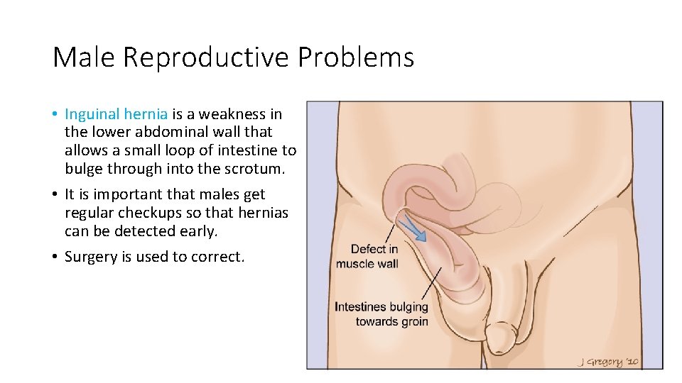 Male Reproductive Problems • Inguinal hernia is a weakness in the lower abdominal wall