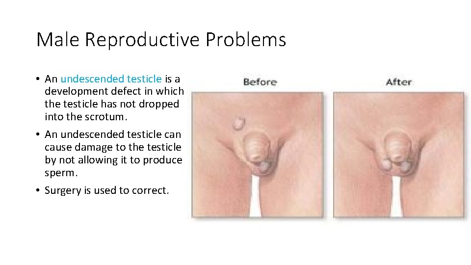 Male Reproductive Problems • An undescended testicle is a development defect in which the