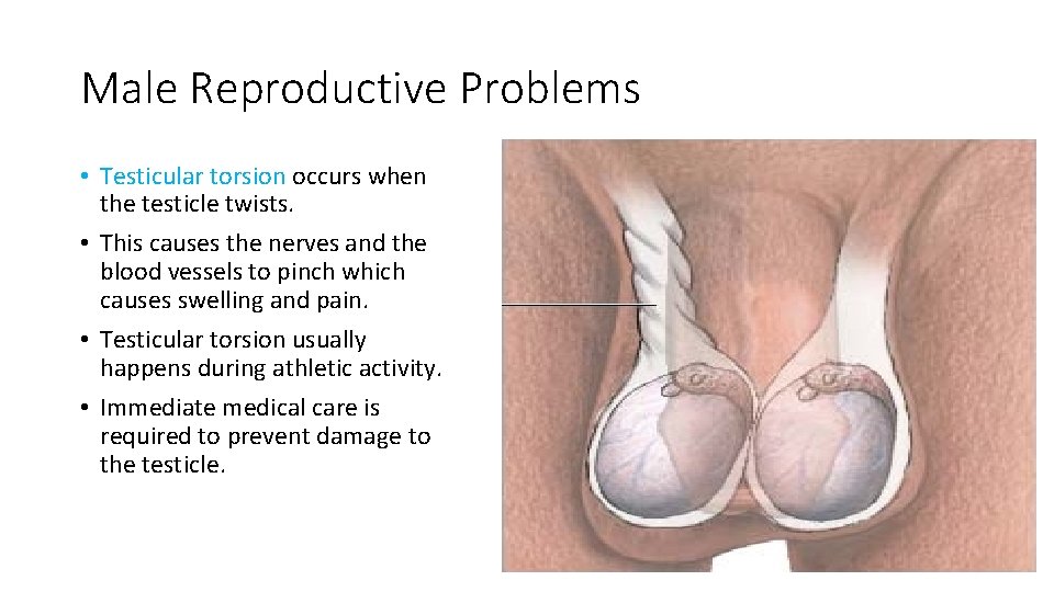 Male Reproductive Problems • Testicular torsion occurs when the testicle twists. • This causes