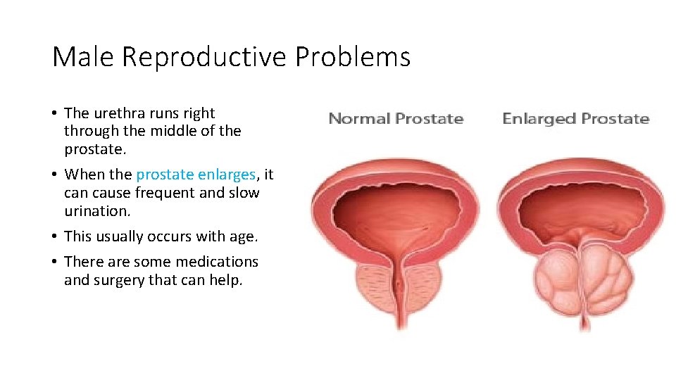 Male Reproductive Problems • The urethra runs right through the middle of the prostate.