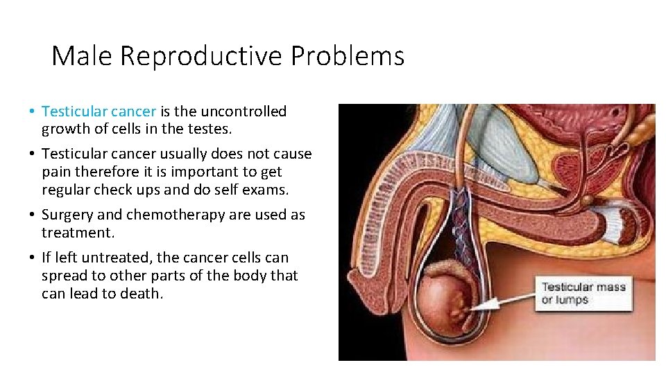 Male Reproductive Problems • Testicular cancer is the uncontrolled growth of cells in the