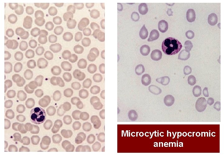Microcytic hypocromic anemia 
