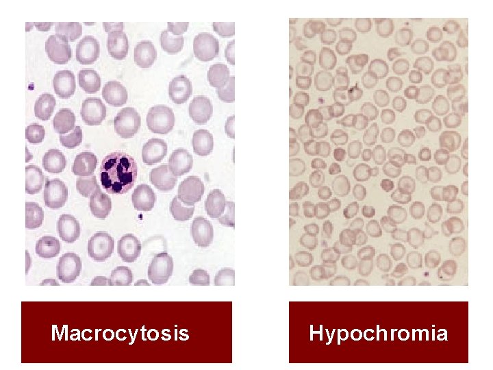 Macrocytosis Hypochromia 